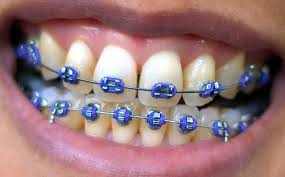 braces.jpg